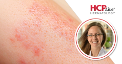 When Blisters Don't Look Like Blisters: Diagnosing Pemphigus, Pemphigoid 