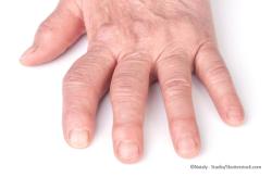 Early Control of Rheumatoid Arthritis Improves Hemostatic Imbalance