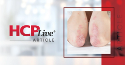 Psoriatic Arthritis Strongly Associated with Metabolic Syndrome and Components