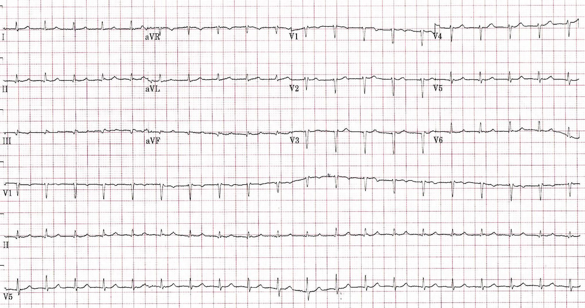 Computer printout of an EKG Strip | Credit: Brady Pregerson, MD