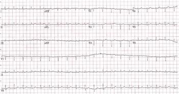 Computer printout of an EKG Strip | Credit: Brady Pregerson, MD
