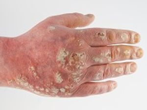 Recognition of Methotrexate Toxicity Key for Patient Treatment