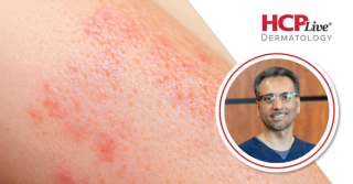 Phase 3 Ritlecitinib Results in Vitiligo, With Iltefat Hamzavi, MD