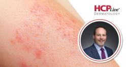 Advances in Treating High-Impact Psoriasis from EADV 2026