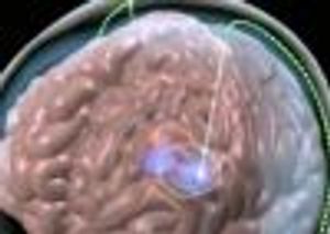 FDA Approves First DBS Device for OCD