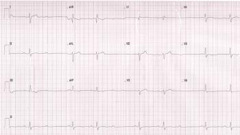 Printout of an ECG from a patient presenting to the emergency department. | Credit: Brady Pregerson, MD
