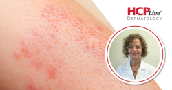 GLOBOSTAD: 3 Year Efficacy of Dupilumab in Atopic Dermatitis, With Silvia Mariel Ferrucci, MD