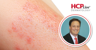 Significance of Roflumilast Approval for Atopic Dermatitis in Children, With Lawrence Eichenfield, MD