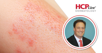 Comparing Roflumilast Cream to Other Topicals for Atopic Dermatitis, With Lawrence Eichenfield, MD