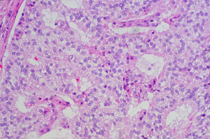 NDA Accepted for Potential Rare Neuroendocrine Tumor Therapy