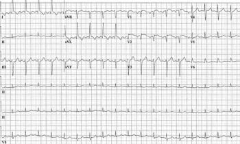 ECG printout from a patient with nonpleuritic chest pain