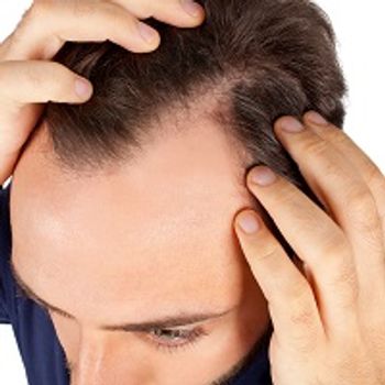 Research Emphasizes High Quality of Life Disease Burden With Alopecia Areata