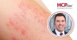 Joints, Weight, and Mental Health: Ixekizumab + Tirzepatide for PsA, With Joseph Merola, MD