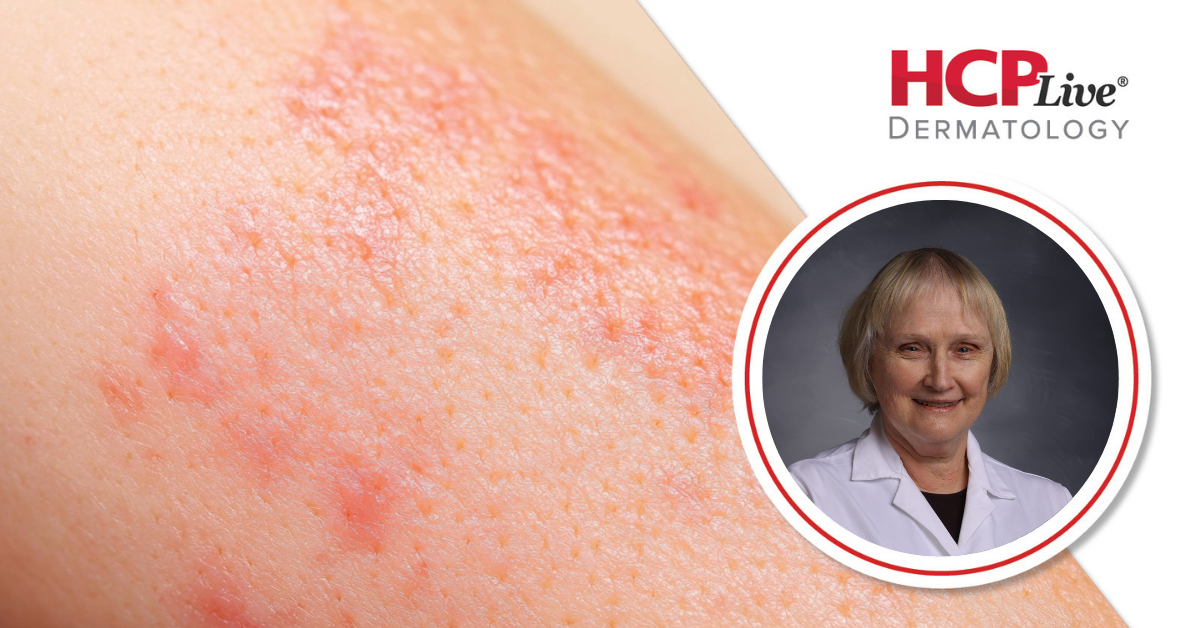 Q&A: 1-Year Efficacy Data on Clascoterone 5% in Androgenetic Alopecia, With Maria Hordinsky, MD