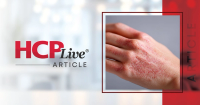 Delgocitinib Cream Shows Consistent CHE Efficacy Across Several Subgroups