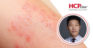 Discussing Future of Amlitelimab, OX40/OX40L Treatment, With Eingun James Song, MD