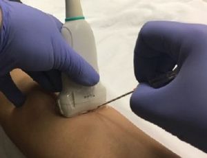 Ultrasound-guided peripheral intravenous from Gottlieb line placement. Reproduced from Gottlieb M. West J Emerg Med 2017; 18(6):1047-1054.