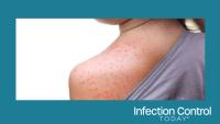 Measles in a young girl.  (Adobe Stock 174366084 by weerapat1003)