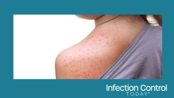 Measles in a young girl.  (Adobe Stock 174366084 by weerapat1003)