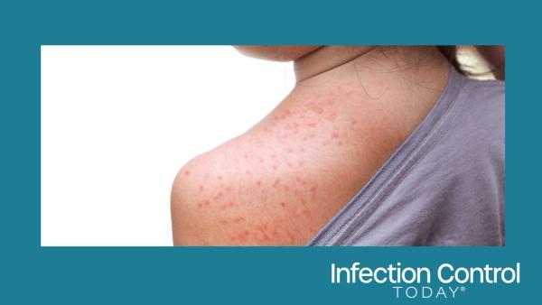 Measles in a young girl. (Adobe Stock 174366084 by weerapat1003)