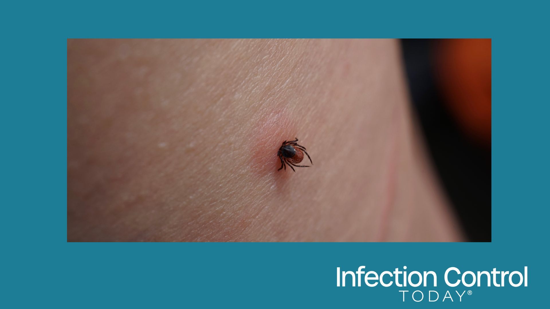 Close-up of a sucking female tick on human irritated skin. The bloated Ixodes ricinus, a dangerous parasite, is biting into the pink, irritated epidermis. Danger of Encephalitis and Lyme disease infection.  (Adobe Stock 449680426 by Sahara Frost)