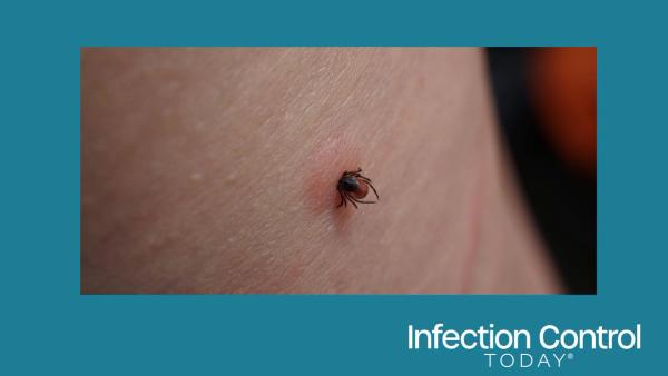 Close-up of a sucking female tick on human irritated skin. The bloated Ixodes ricinus, a dangerous parasite, is biting into the pink, irritated epidermis. Danger of Encephalitis and Lyme disease infection. (Adobe Stock 449680426 by Sahara Frost)