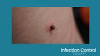 Close-up of a sucking female tick on human irritated skin. The bloated Ixodes ricinus, a dangerous parasite, is biting into the pink, irritated epidermis. Danger of Encephalitis and Lyme disease infection. (Adobe Stock 449680426 by Sahara Frost)
