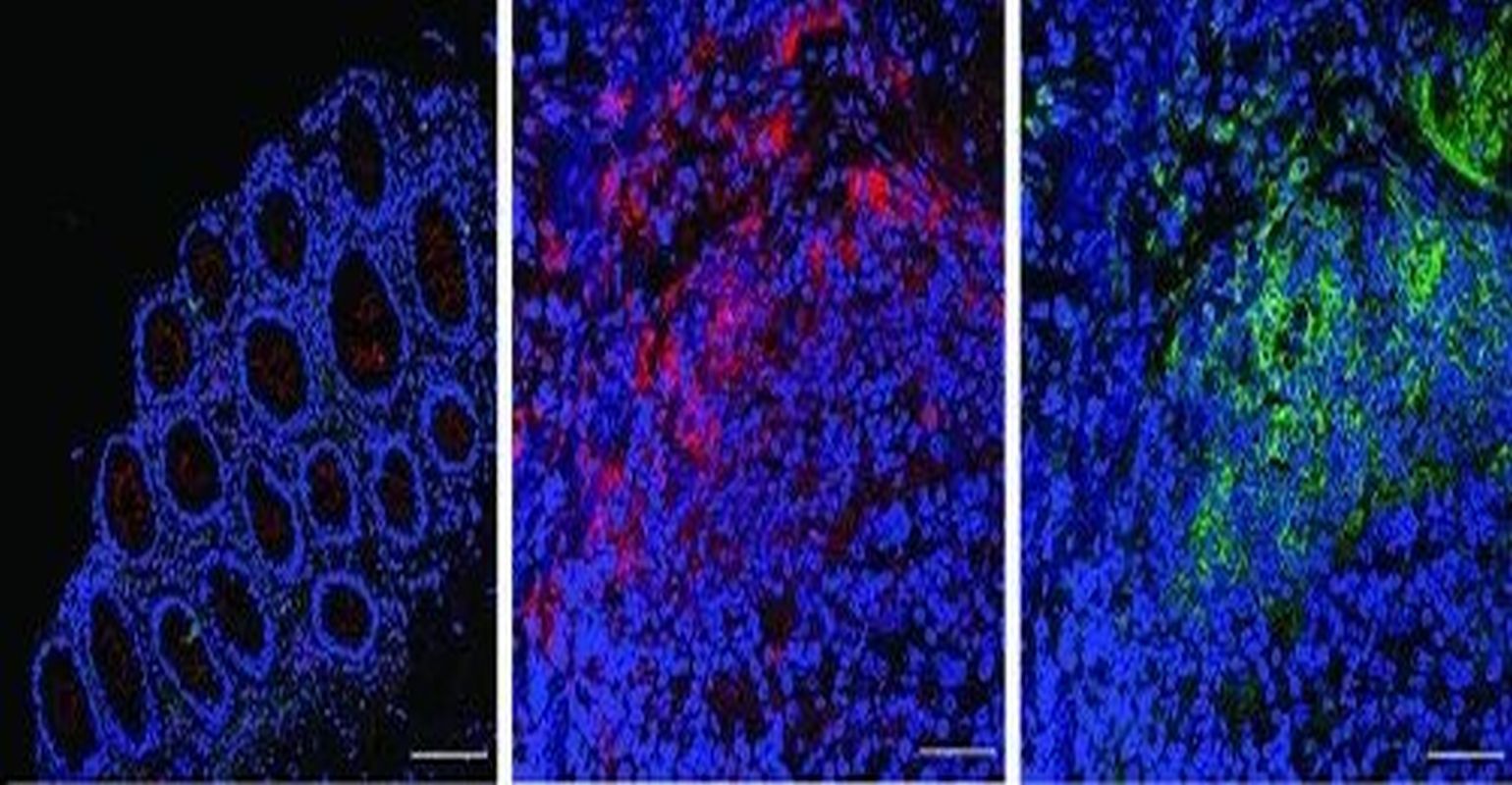 how-a-common-oral-bacteria-makes-colon-cancer-more-deadly-infection