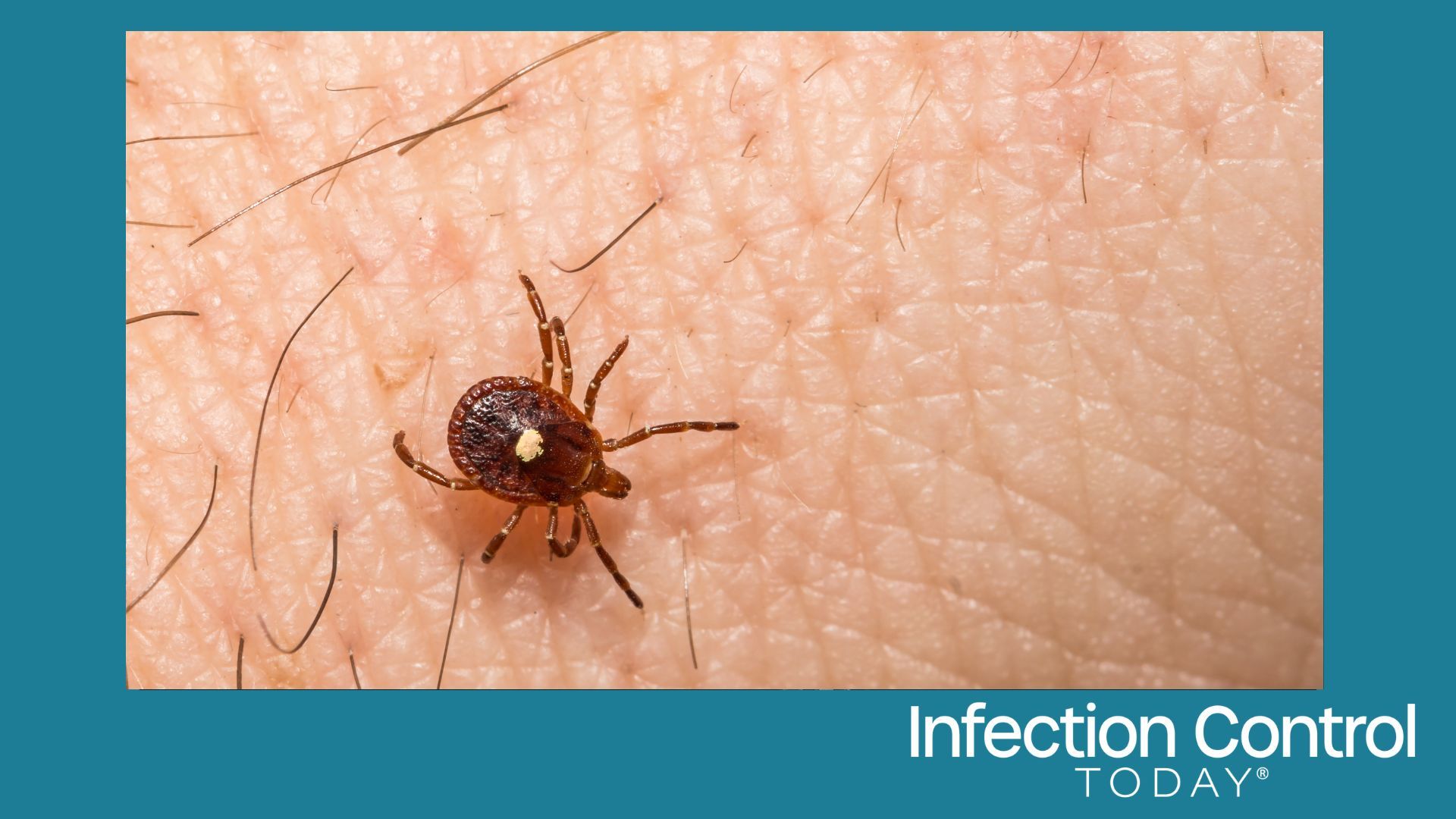 New Bourbon Virus Case Highlights a Rare Tickborne Disease Many Clinicians May Miss