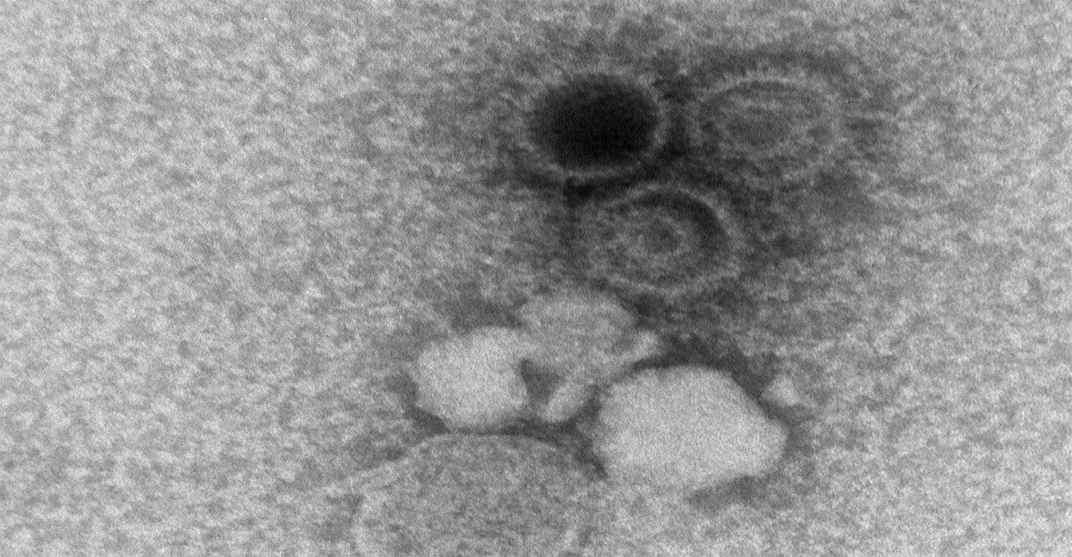 Epstein Barr Virus