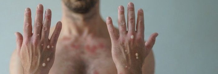 Man showing hands with monkeypox