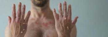 Man showing hands with monkeypox