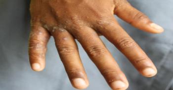 Scabies  (Adobe Stock, unknown)