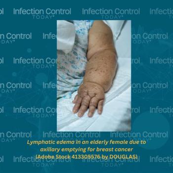 Lymphatic edema in an elderly female due to axillary emptying for breast cancer  (Adobe Stock 413305576 by DOUGLAS)