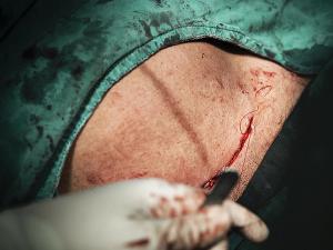 Post-Operative Strategies for Reducing Surgical Site Infection After Cesarean Section 