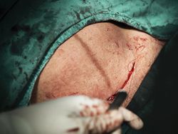 Post-Operative Strategies for Reducing Surgical Site Infection After Cesarean Section 