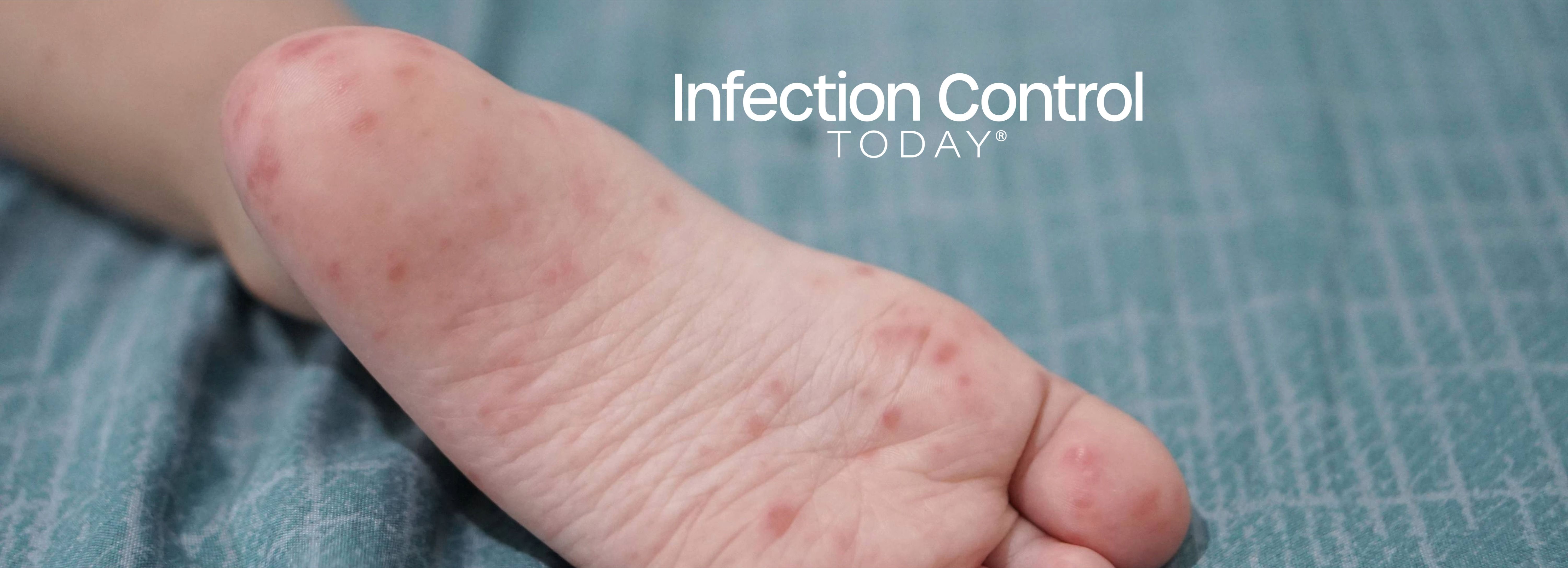 A close-up of a child's feet infected with hand-foot-and-mouth disease (HFMD), caused by enterovirus or coxsackievirus, in a zoom shot.  (Adobe Stock 761848394 by thebaikers)
