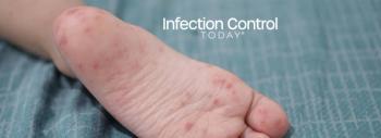 A close-up of a child's feet infected with hand-foot-and-mouth disease (HFMD), caused by enterovirus or coxsackievirus, in a zoom shot.  (Adobe Stock 761848394 by thebaikers)