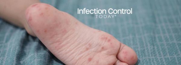 A close-up of a child's feet infected with hand-foot-and-mouth disease (HFMD), caused by enterovirus or coxsackievirus, in a zoom shot.  (Adobe Stock 761848394 by thebaikers)