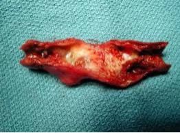Photo of an unhealthy carotid artery with plaque in it.  (Photo credit: William Shutze, MD, FACS)