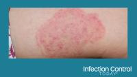 Fungal infection called Trichophyton indotineae in thigh of child. Ringworm. (Adobe Stock by ZAY WIN HTAI)