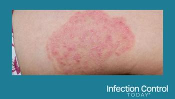 Fungal infection called Trichophyton indotineae in thigh of child. Ringworm. (Adobe Stock by ZAY WIN HTAI)