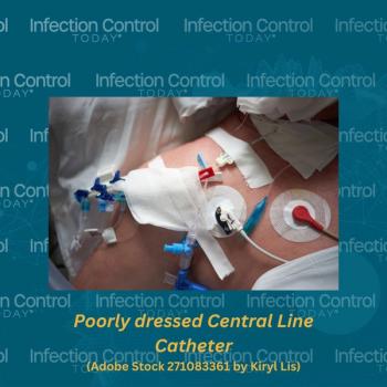 Poorly dressed central line catheter  (Adobe Stock 271083361 by Kiryl Lis)