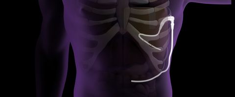 Pleural Dynamics' ACES device: ©Pleural Dynamics