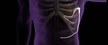 Pleural Dynamics' ACES device: ©Pleural Dynamics