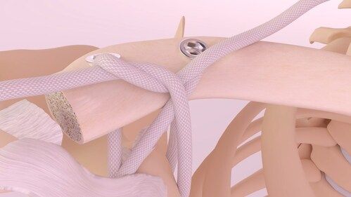 Movmedix LARS shoulder ligament system wins FDA clearance: ©Movemedix