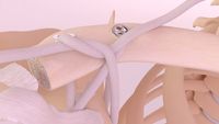 Movmedix LARS shoulder ligament system wins FDA clearance: ©Movemedix