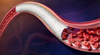 BD achieves milestone in AGILITY study for Revello stent: ©BD