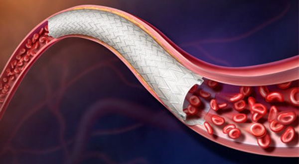 BD achieves milestone in AGILITY study for Revello stent: ©BD