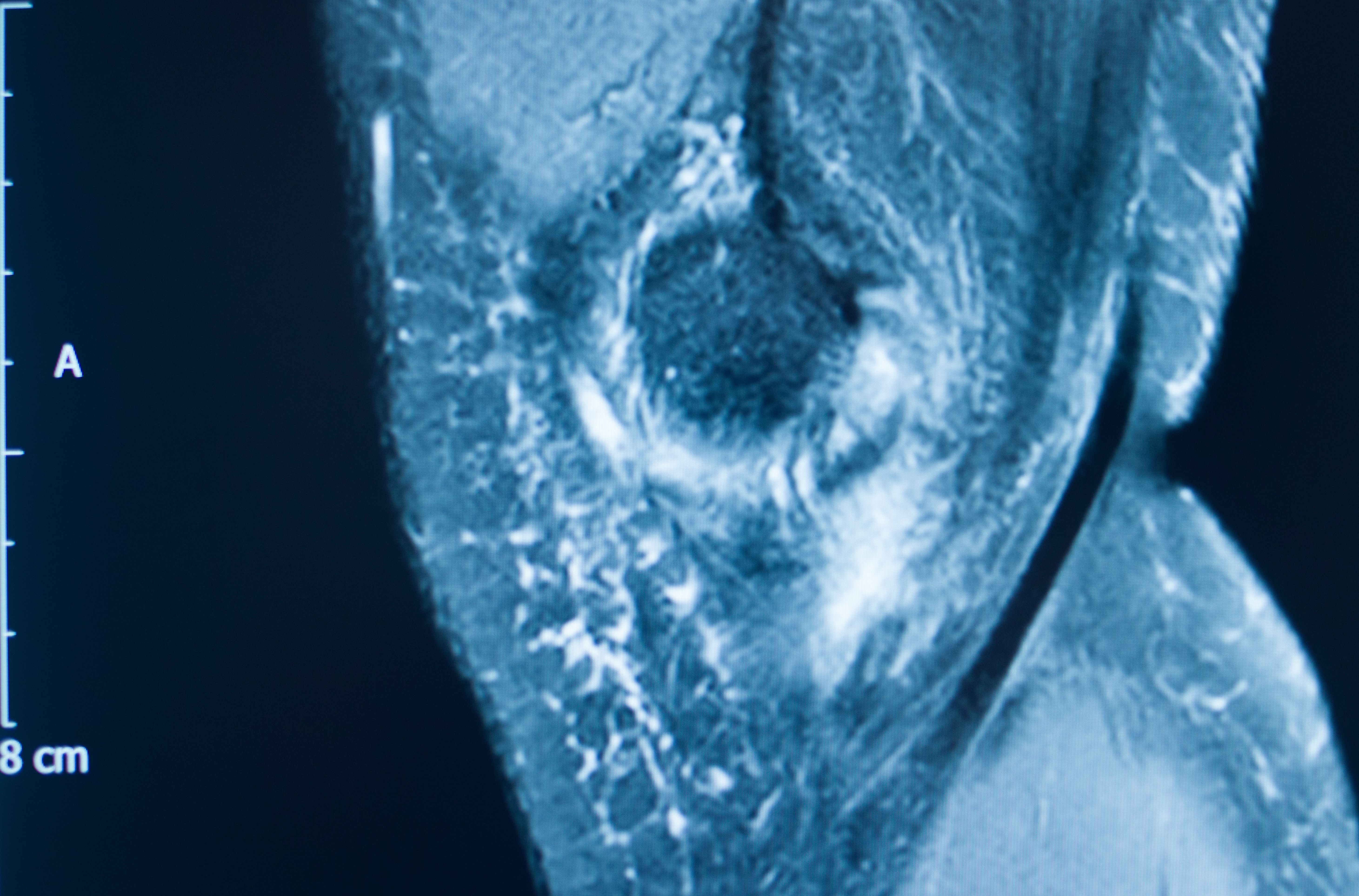 OSSIO's bio-integrative suture anchors can be used in a wide variety of procedures: ©EdwardOlive - stock.adobe.com